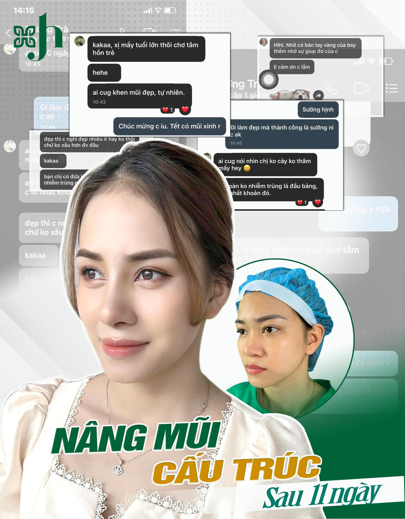 Nâng Mũi Cấu Trúc Đẹp - An Toàn tại Vinh Nghệ An