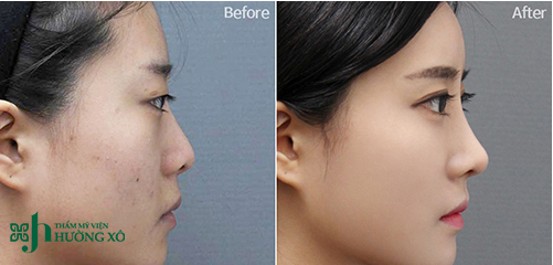 Nên Nâng Mũi Bọc Sụn Hay Nâng Mũi Cấu Trúc Tại Nghệ An