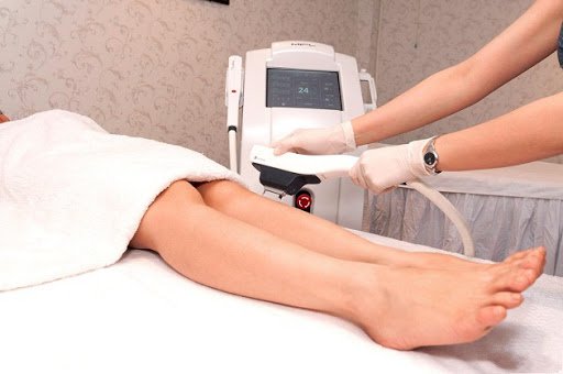 Triệt Lông Với Công Nghệ Laser Diode Tại Vinh
