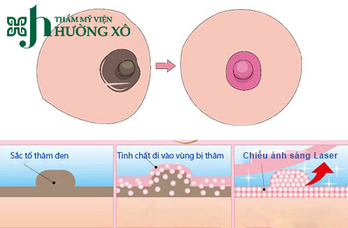 Làm Hồng Nhũ Hoa Bằng Công Nghệ Laser Tại Vinh