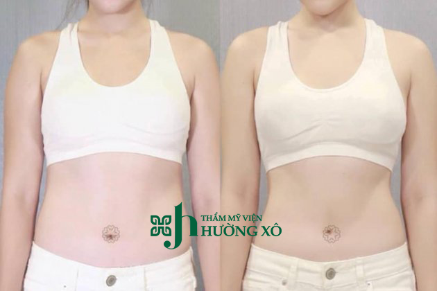 Công Nghệ Giảm Béo Cavi Lipo Tại Vinh, Nghệ An