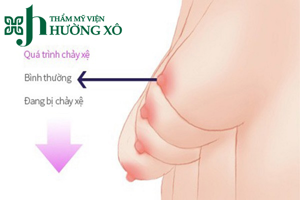 Treo Ngực Sa Trễ Chất Lượng Tại Vinh