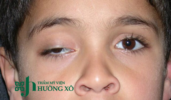 Phẫu Thuật Sụp Mí Mắt Chất Lượng Tại Vinh, Nghệ An