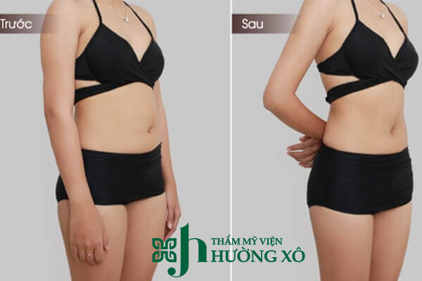 Địa Chỉ Hủy Mỡ Max Thin Lipo Uy Tín Tại Vinh, Nghệ An