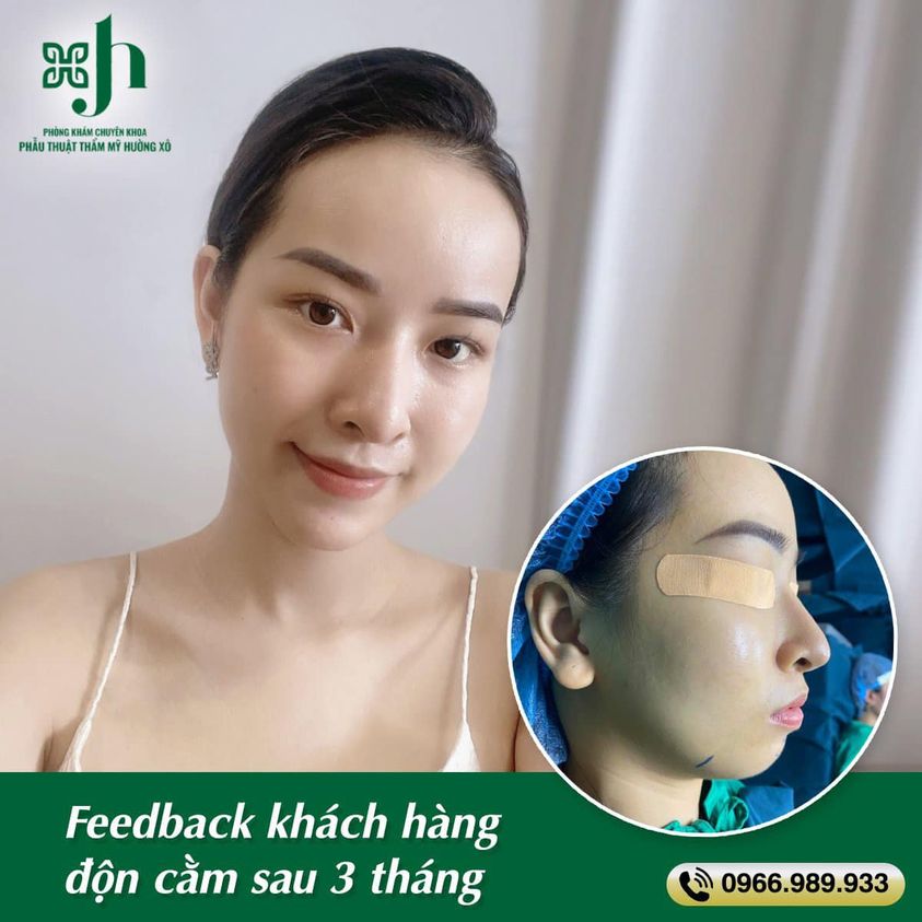 Dịch Vụ Độn Cằm Uy Tín Tại Vinh, Nghệ An