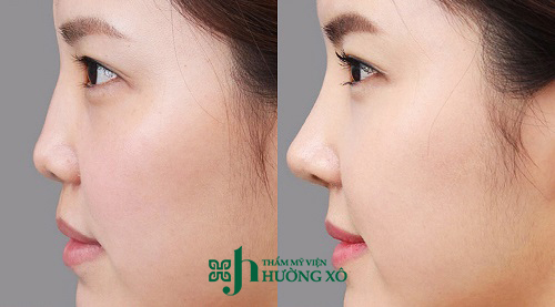 Nâng Mũi Bán Cấu Trúc Tại Vinh Và Những Điều Cần Biết