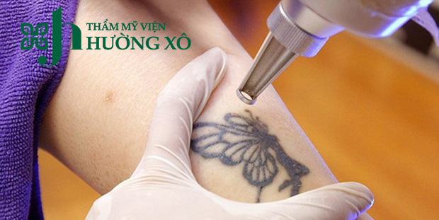 Dịch Vụ Xóa Hình Xăm Chất Lương Tại Vinh, Nghệ An