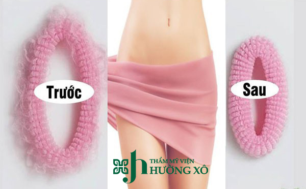 Dịch Vụ Trẻ Hóa Âm Đạo Uy Tín Tại Hà Tĩnh