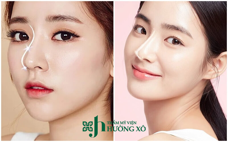 Địa Chỉ Nâng Mũi Hàn Quốc Chất Lượng Tại Vinh
