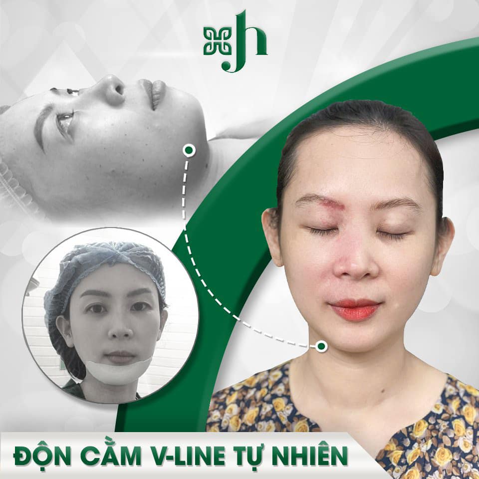 Địa Chỉ Độn Cằm Chất Lượng Tại Vinh, Nghệ An