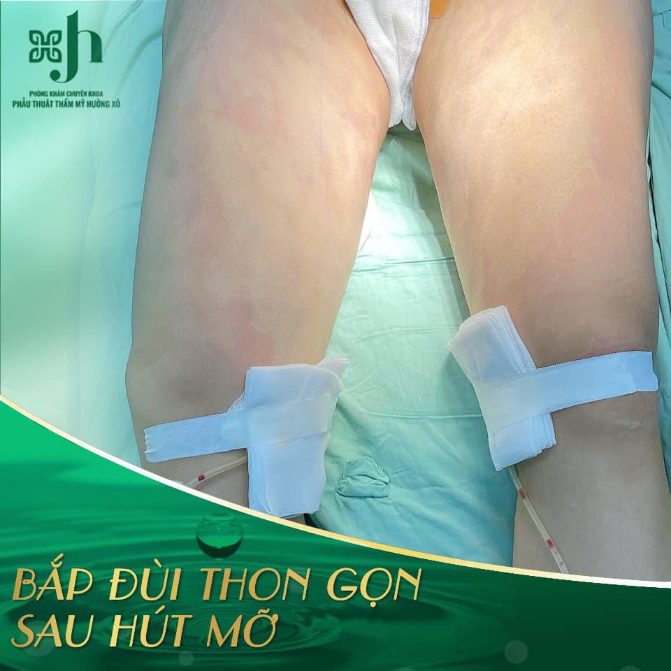HÚT MỠ ĐÙI VÀ NHỮNG ĐIỀU CẦN BIẾT
