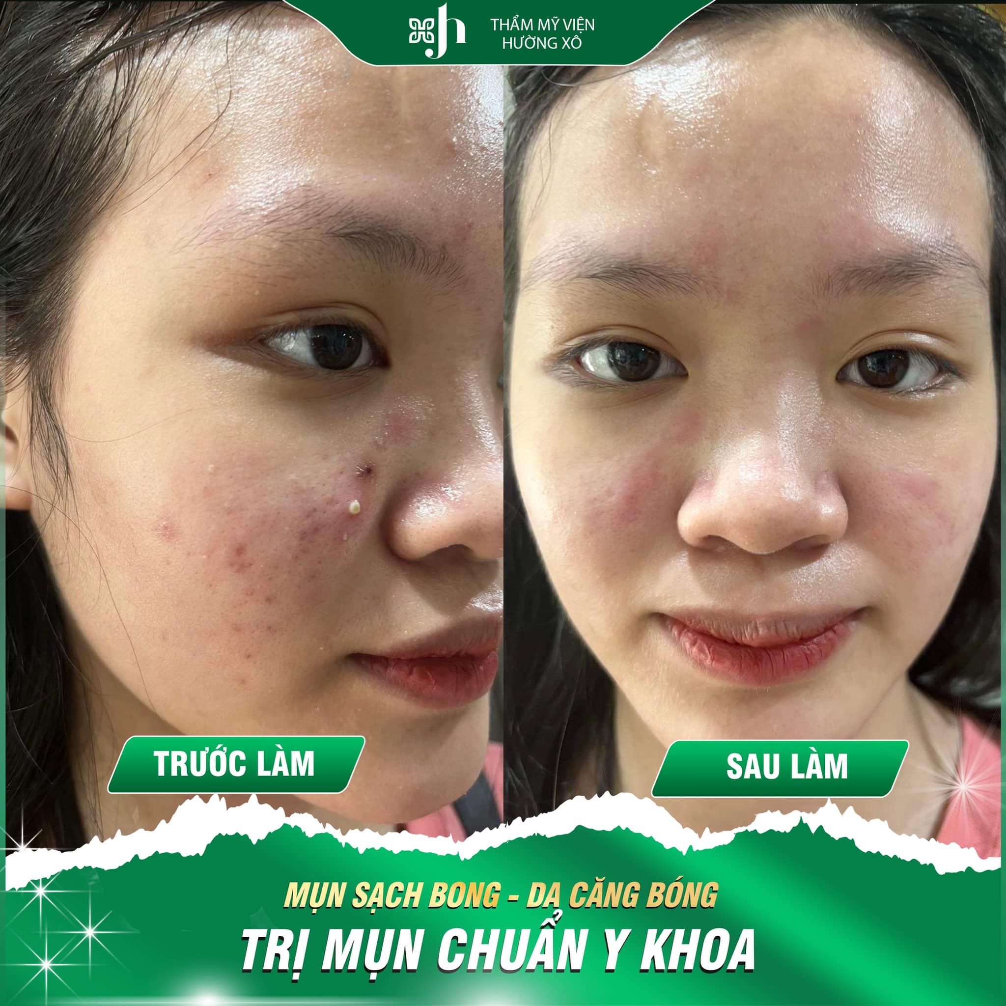 Địa Chỉ Điều Trị Da Mụn - Thâm Sau Mụn Tại Vinh, Nghệ An