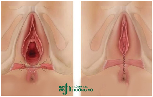 Dịch Vụ Tái Tạo Tầng Sinh Môn Uy Tín Tại Vinh