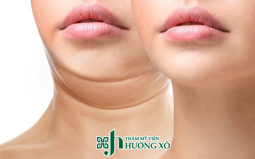 Dịch Vụ Tiêm Tan Nọng Cằm Uy Tín Tại Vinh, Nghệ An