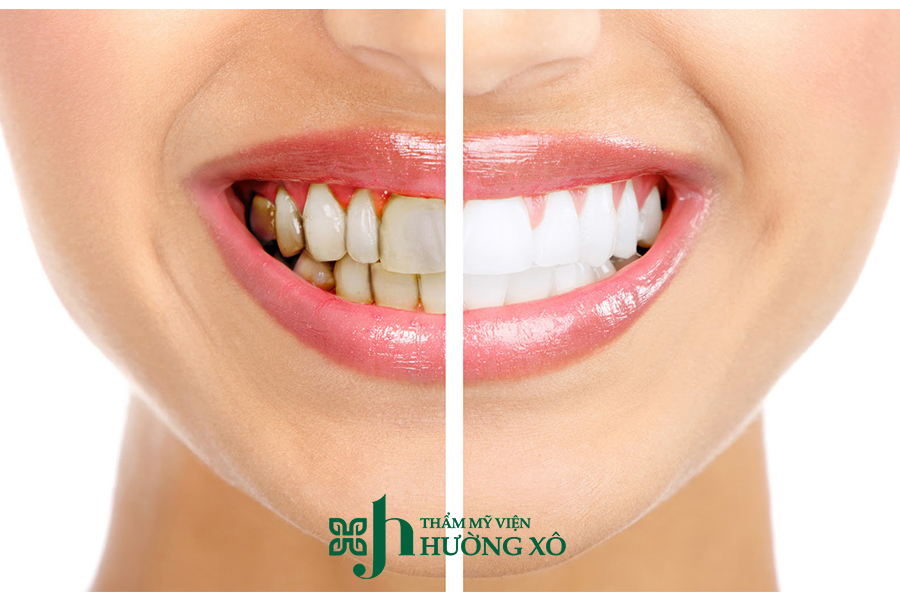 Dịch Vụ Tẩy Trắng Răng Tại Vinh, Nghệ An