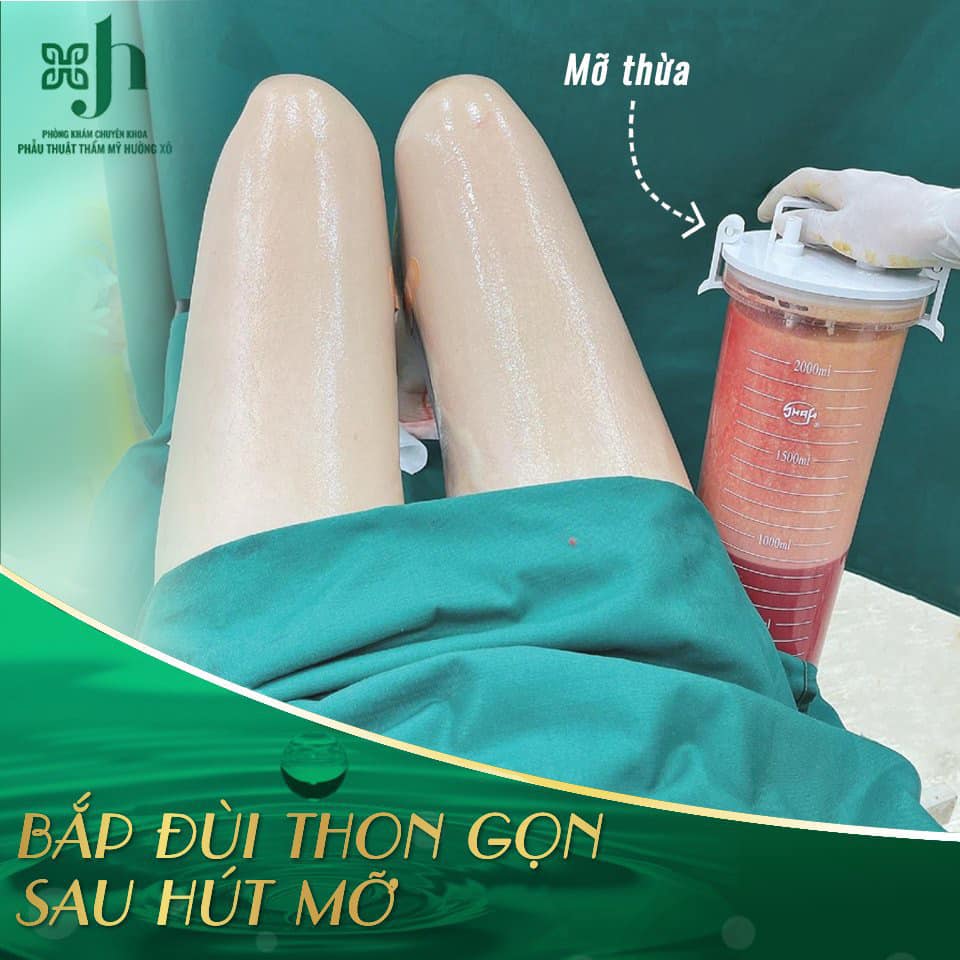 Địa Chỉ Hút Mỡ Vaser Lipo Uy Tín Tại Vinh, Nghệ An