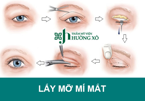 Địa Chỉ Lấy Mỡ Mí Mắt Trên Uy Tín Tại Vinh