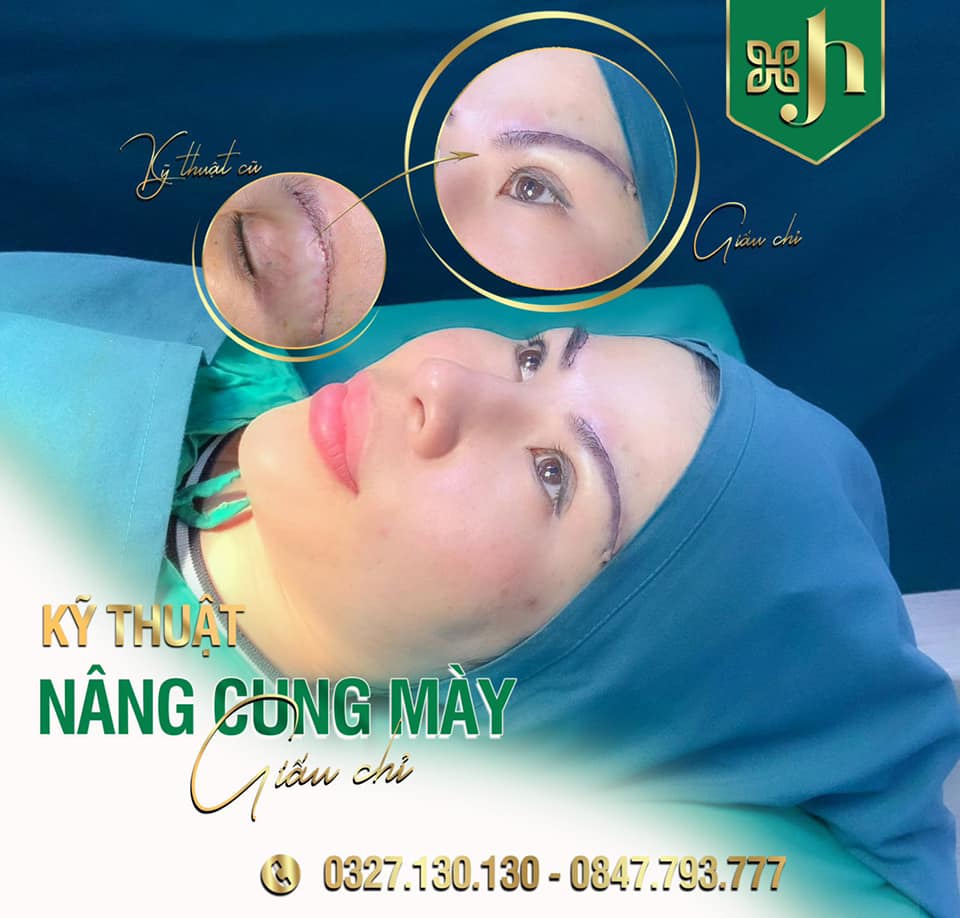Địa Chỉ Nâng Cung Chân Mày Uy Tín Tại Vinh
