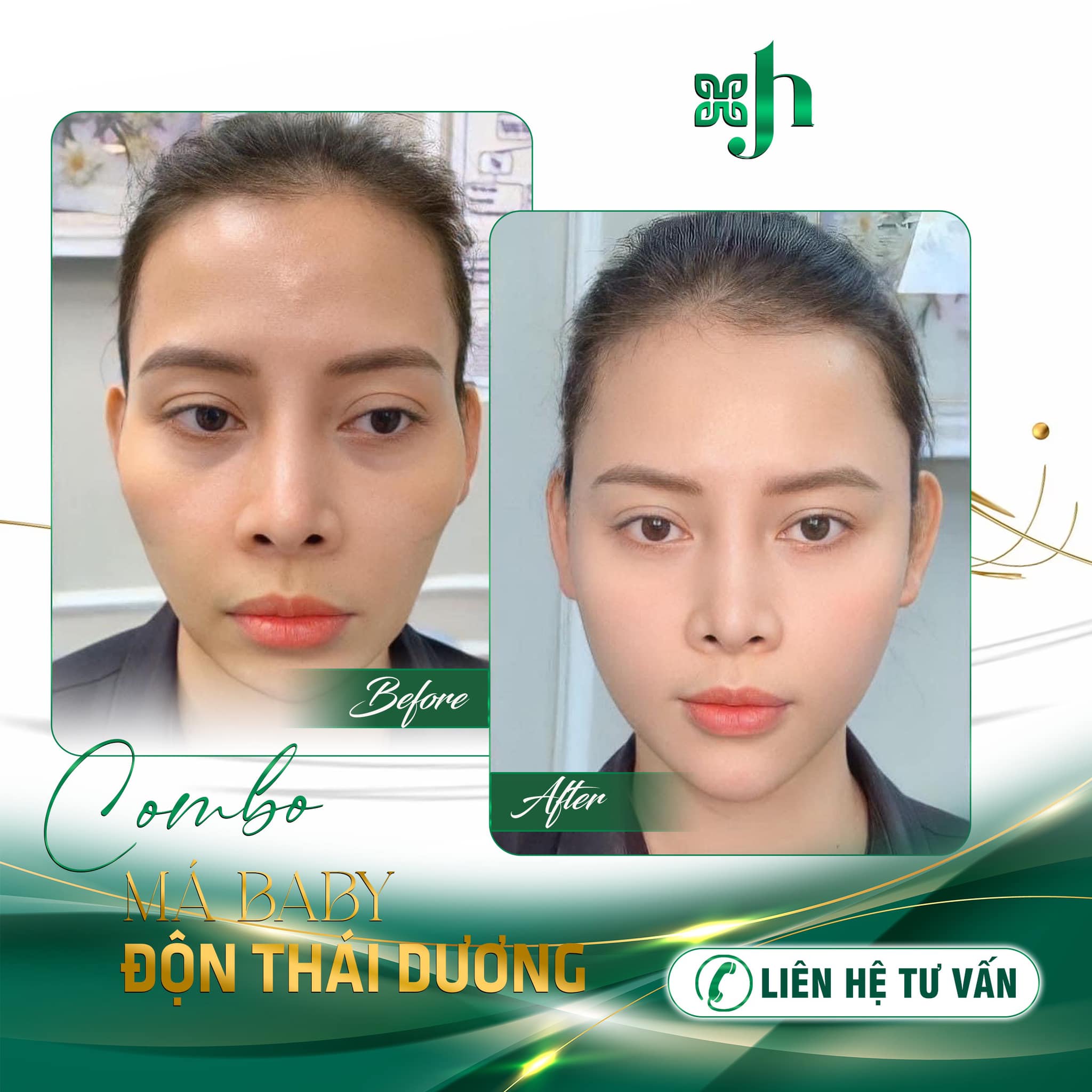 Địa Chỉ Độn Thái Dương Uy Tín Tại Vinh