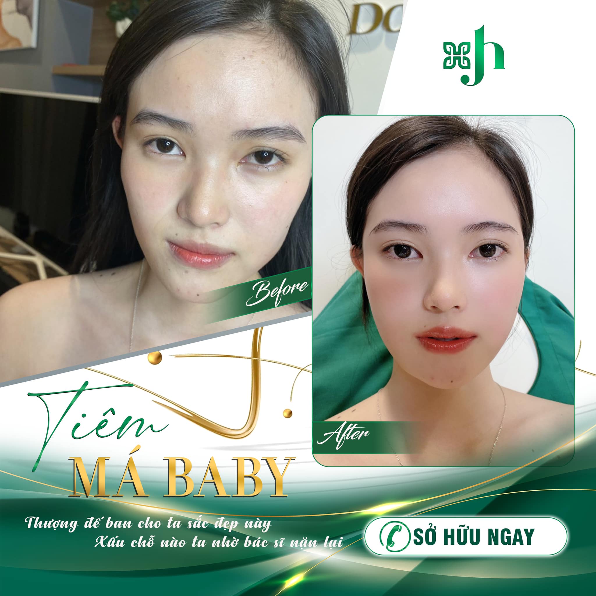 Dịch Vụ Tiêm Má Baby Uy Tín Tại Vinh Nghệ An