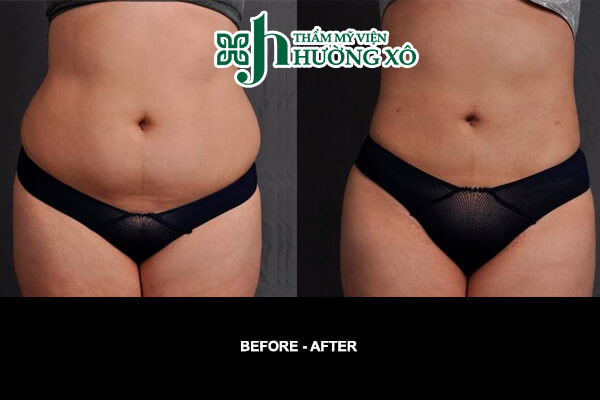 Dịch Vụ giảm Béo Smart Lipo Uy Tín Tại Nghệ An