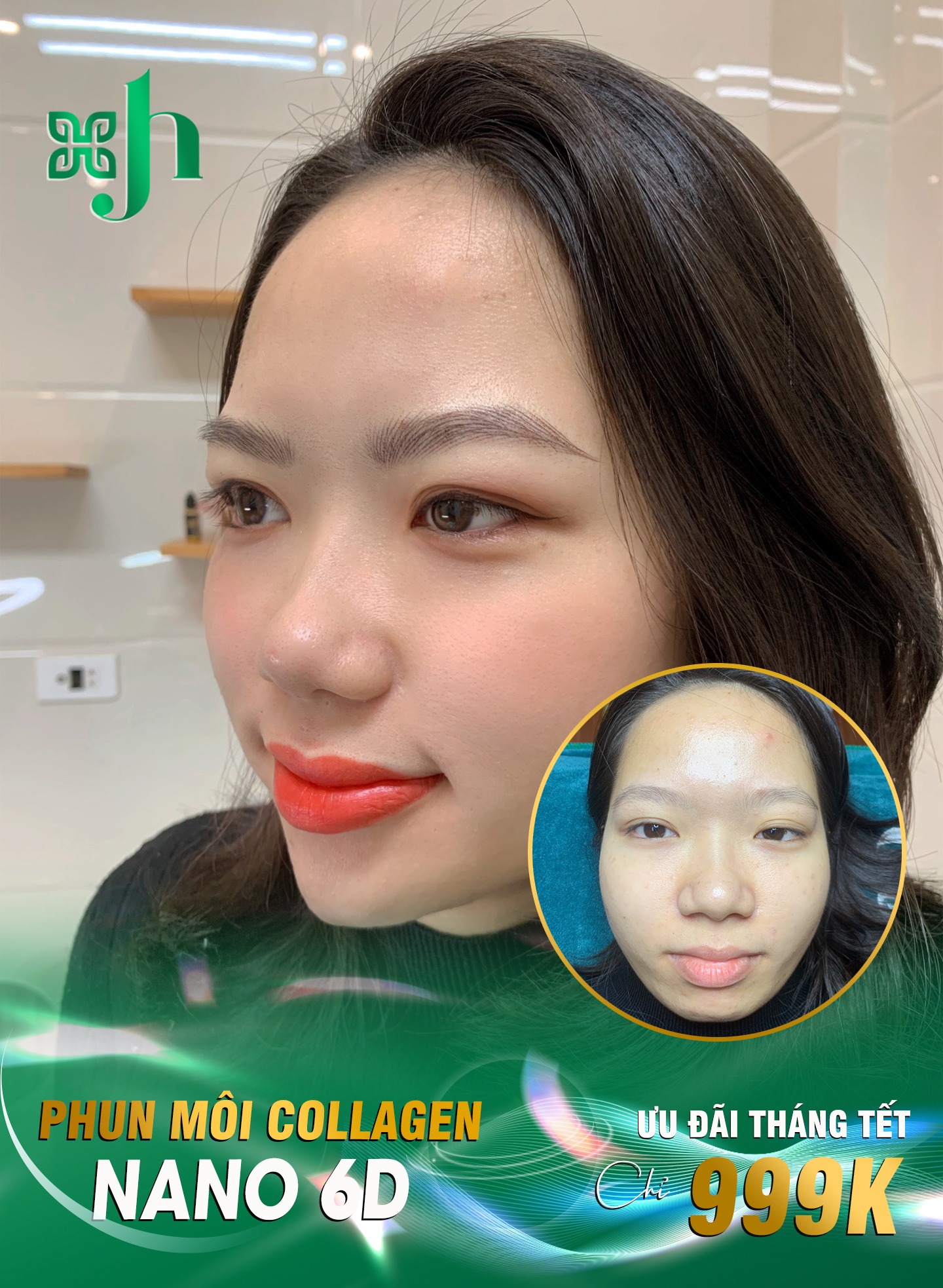 Có Nên Phun Môi Collagen Tại Vinh, Nghệ An