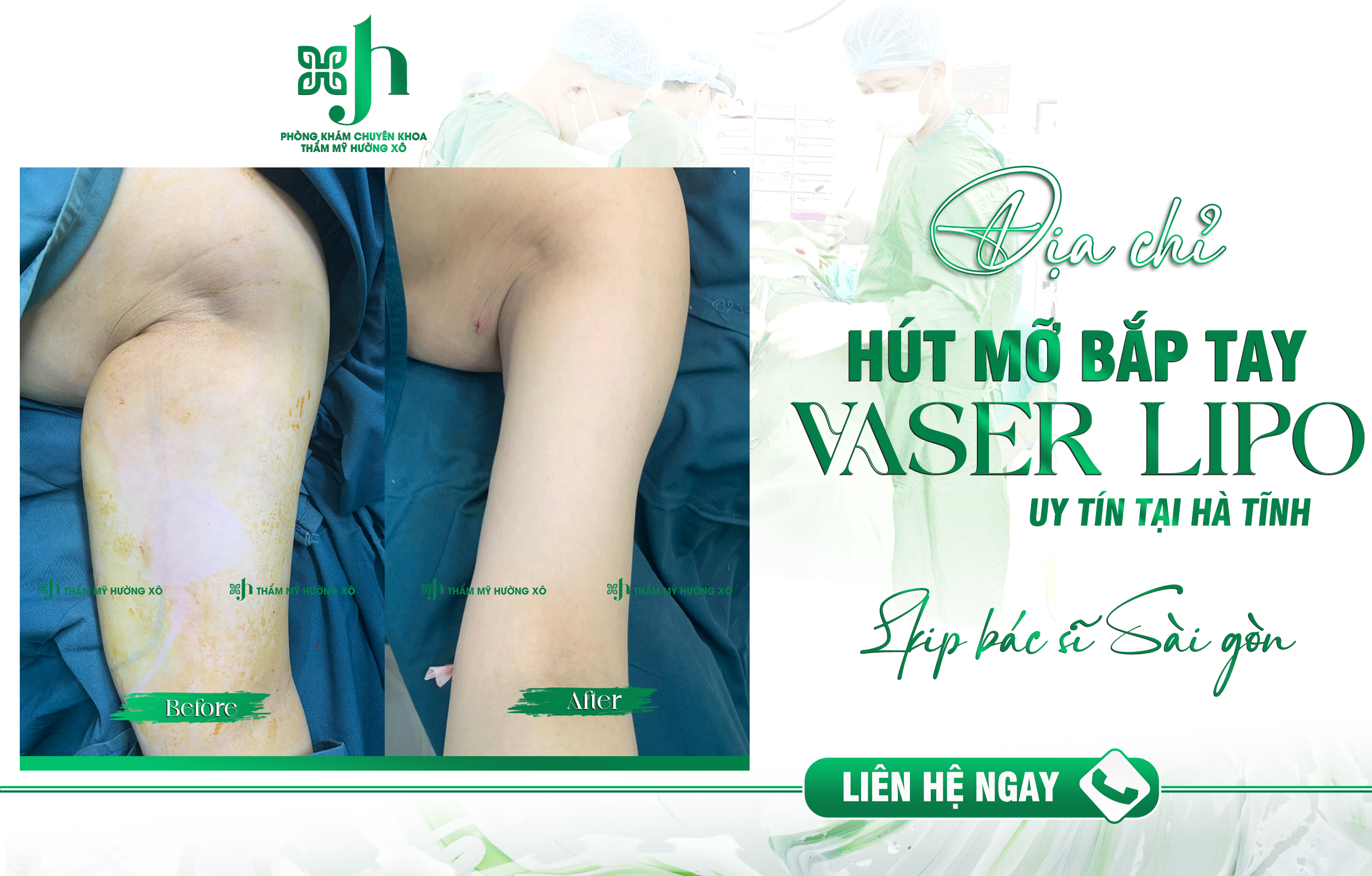 Dịch Vụ Hút Mỡ Vaser Lipo Uy Tín Tại Hà Tĩnh