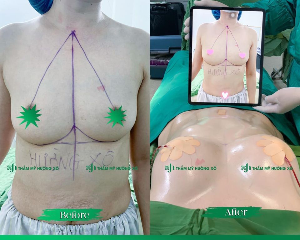 Khám Phá Dịch Vụ Nâng Ngực Không Chạm Uy Tín Tại Vinh