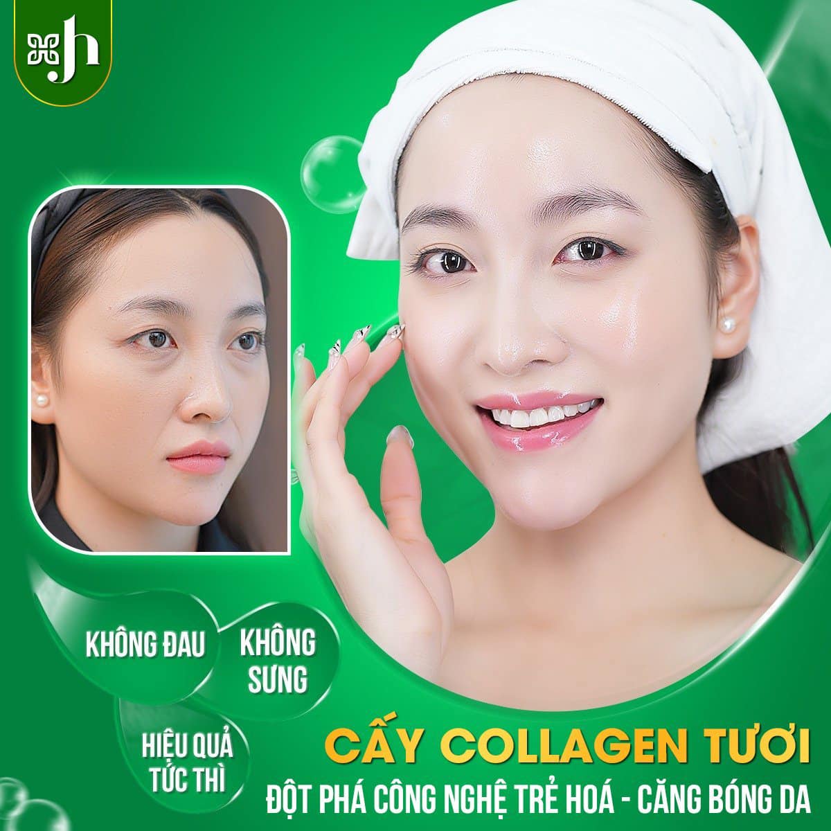 Dịch Vụ Cấy Collagen Tươi Uy Tín Tại Hà Tĩnh