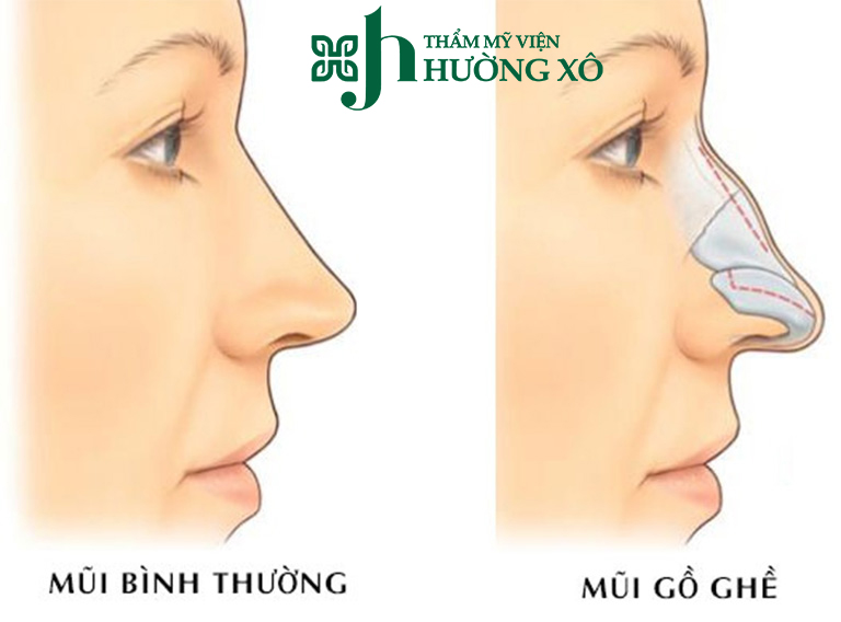Trải Nghiệm Dịch Vụ Mài Gồ Xương Mũi Uy Tín Tại Vinh