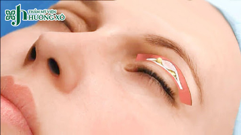 Dịch Vụ Cắt Mí Nội Soi Uy Tín Tại Vinh