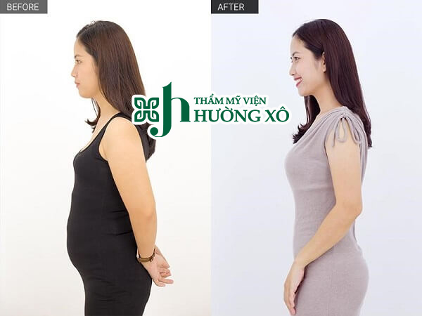 Địa Chỉ Giảm Béo Contri Lipo Uy Tín Tại Vinh