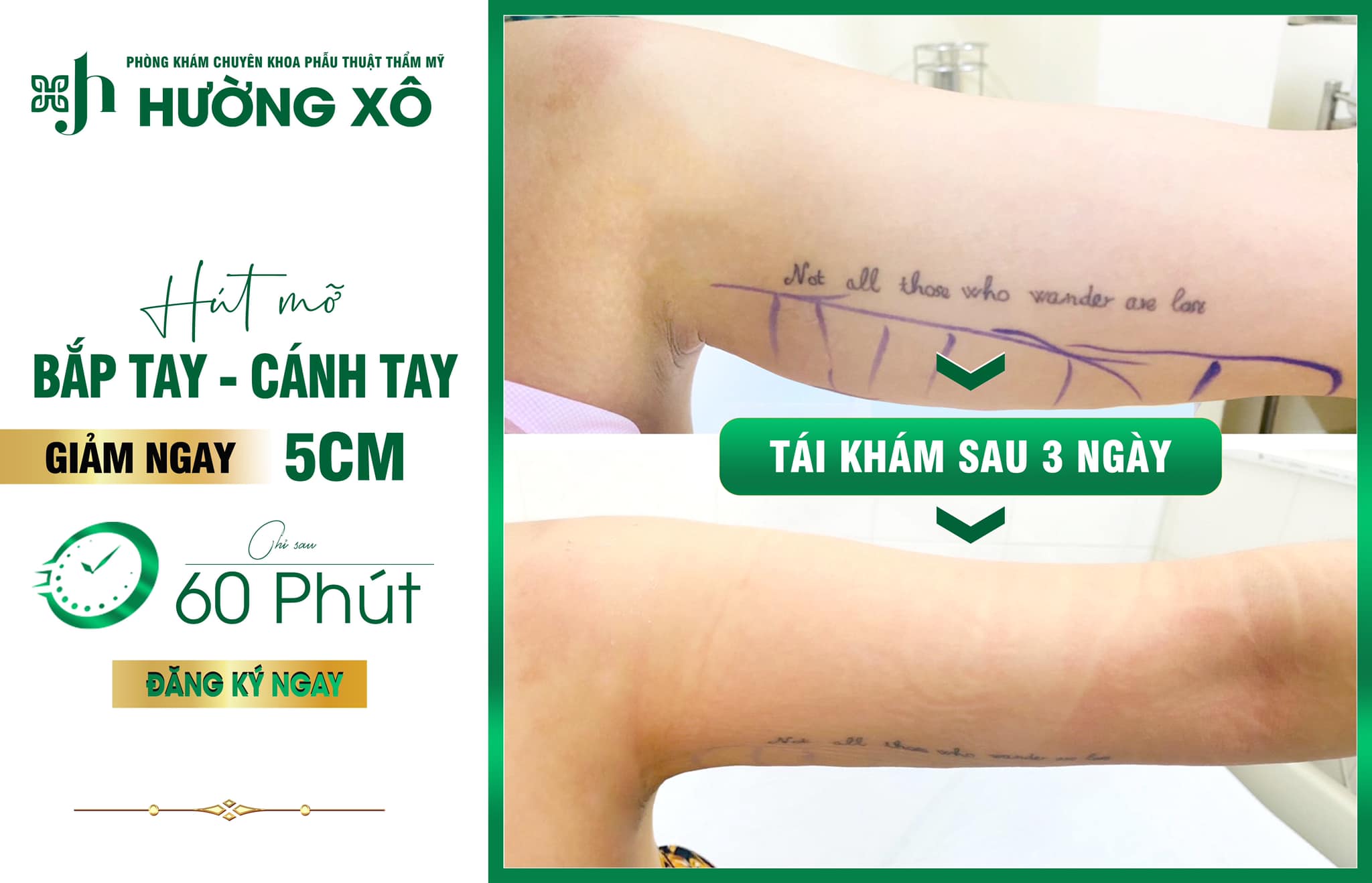 Địa Chỉ Hút Mỡ Uy Tín Tại Vinh
