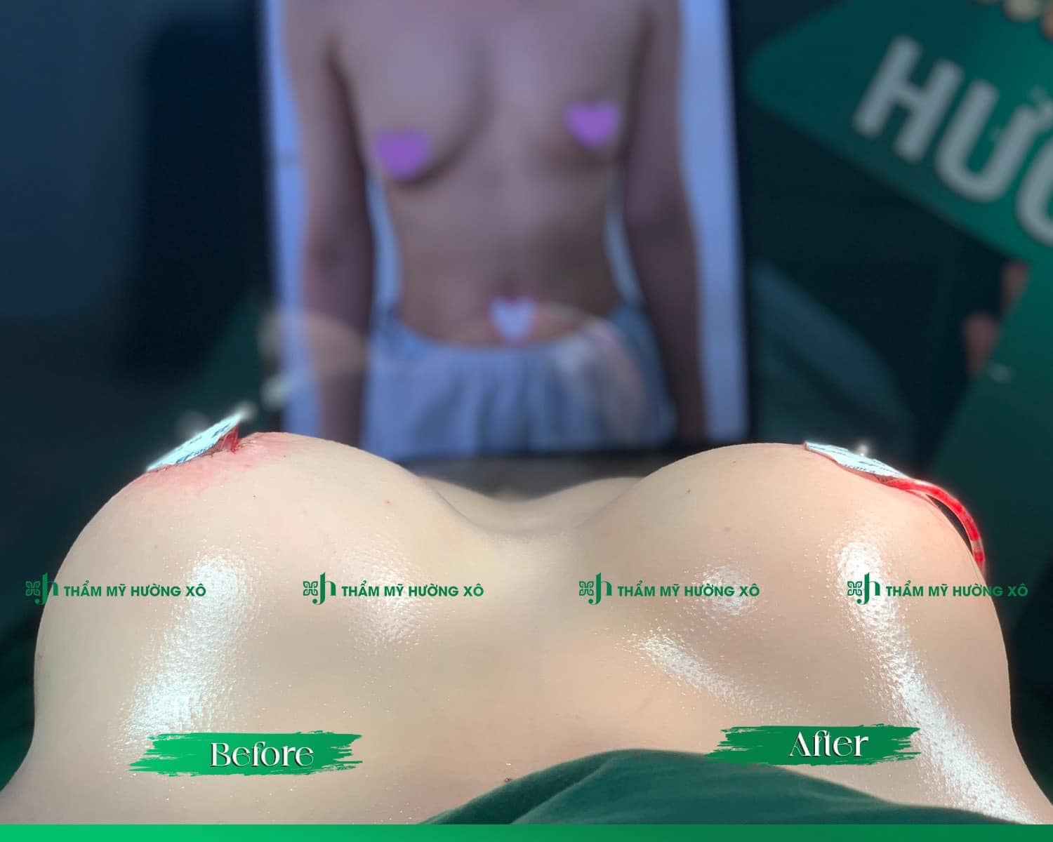 Địa Chỉ Nâng Ngực Không Chám Uy Tín Tại Hà Tĩnh