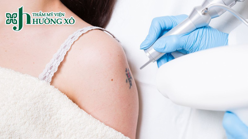 Dịch Vụ Xoá Xăm Uy Tín Tại Vinh