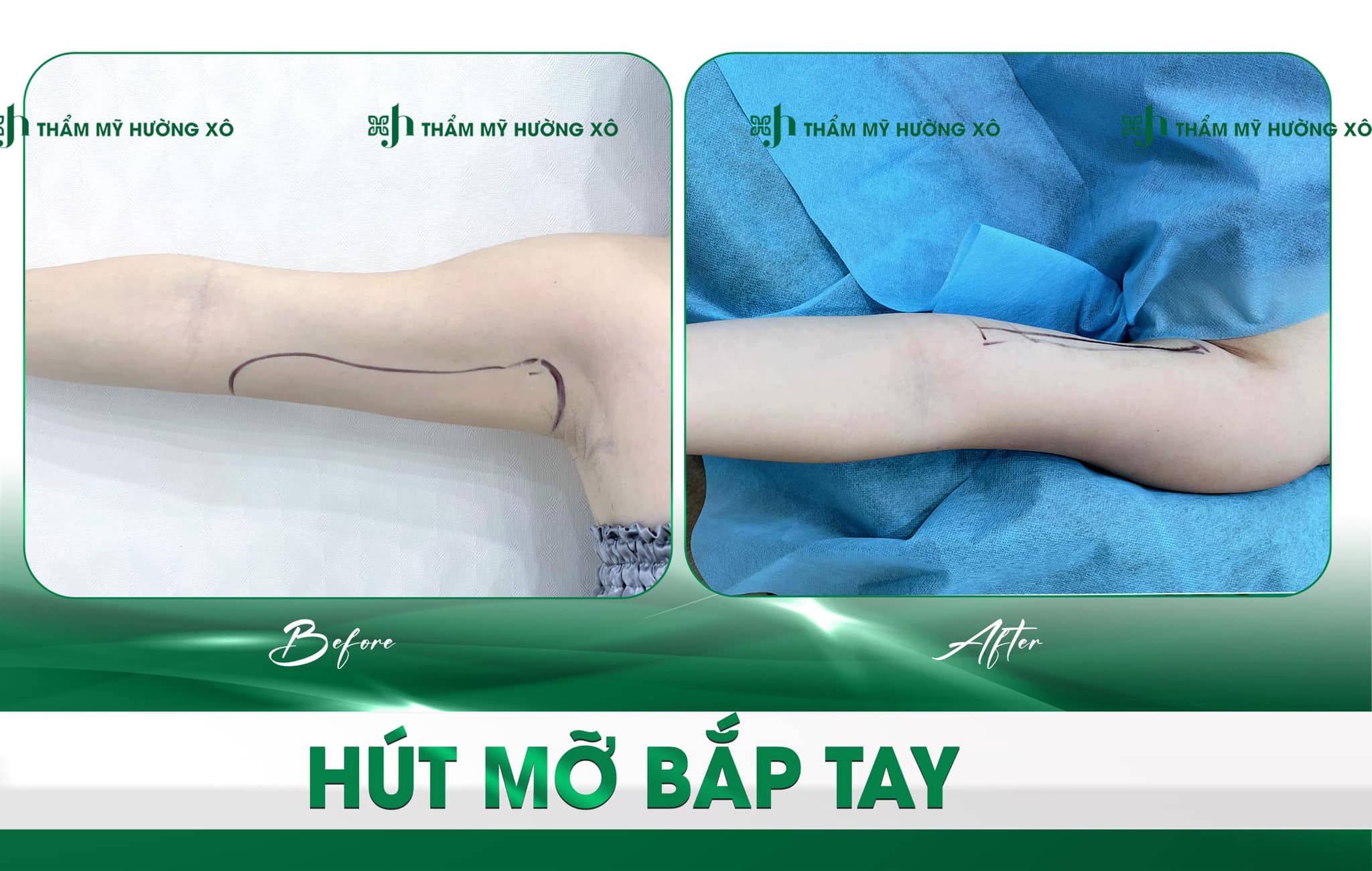 Tìm Hiểu Về Dịch Vụ Hút Mỡ Uy Tín Tại Vinh
