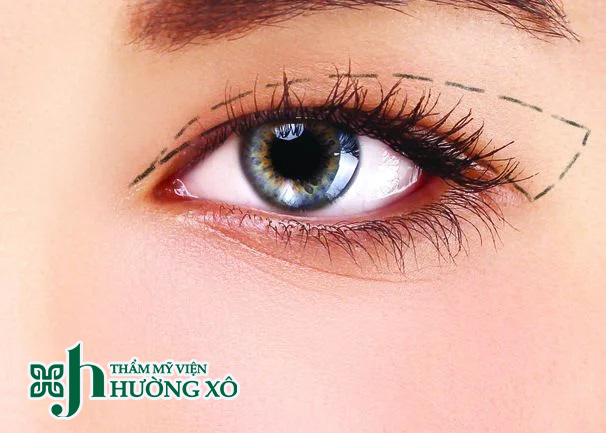 Khám Phá Địa Chỉ Cắt Mí Mắt Uy Tín Tại Hà Tĩnh