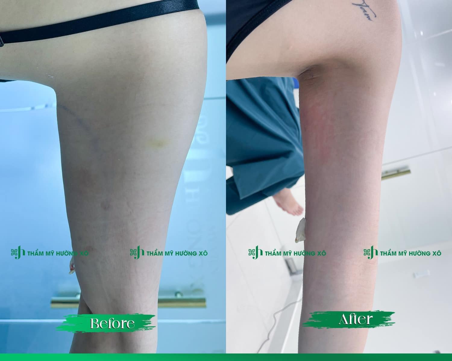 Dịch Vụ Hút Mỡ Vaser Lipo Uy Tín Tại Vinh