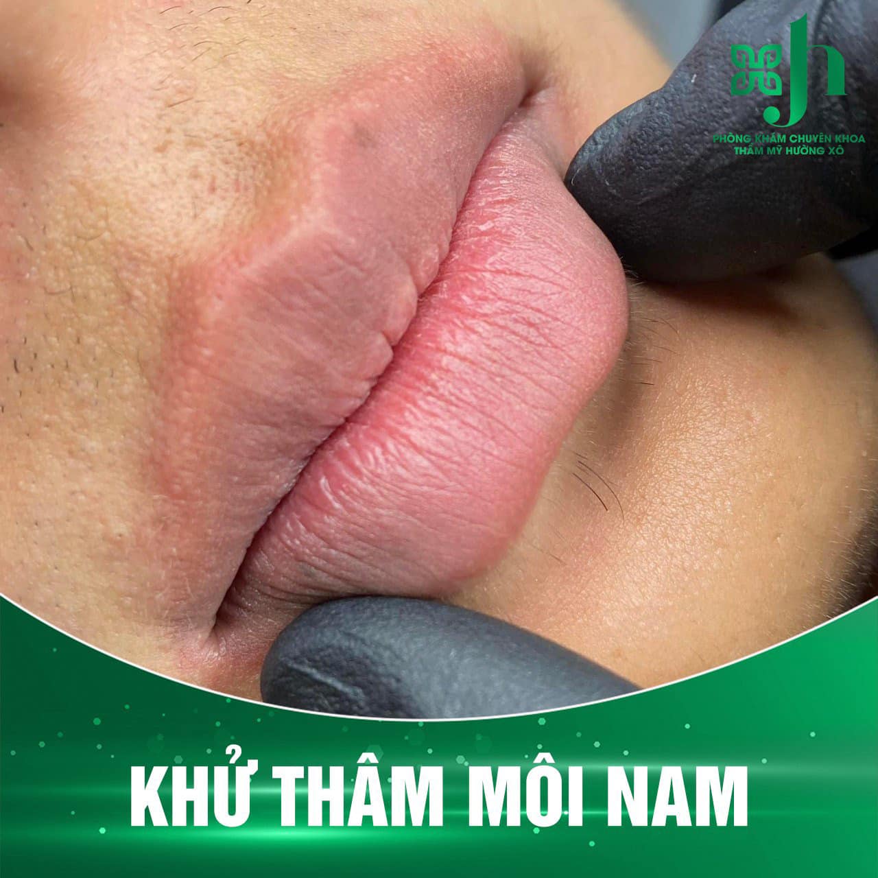 Dịch Vụ Khử Thâm Môi Uy Tín Tại Hà Tĩnh