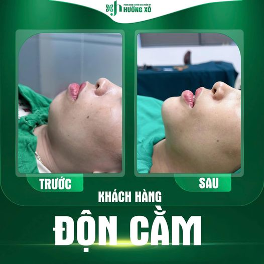 Khám Phá Dịch Vụ Độn Cằm Uy Tín Tại Hà Tĩnh