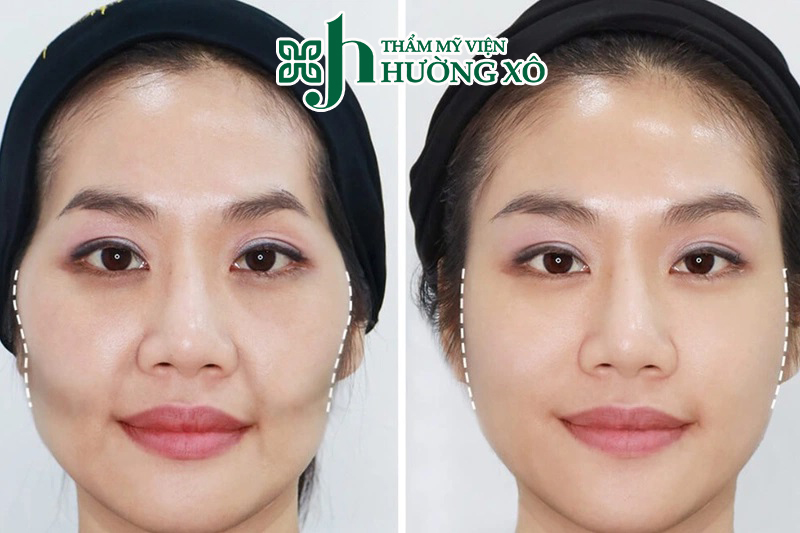 Trải Nghiệm Dịch Vụ Tiêm Má Baby Uy Tín Tại Vinh