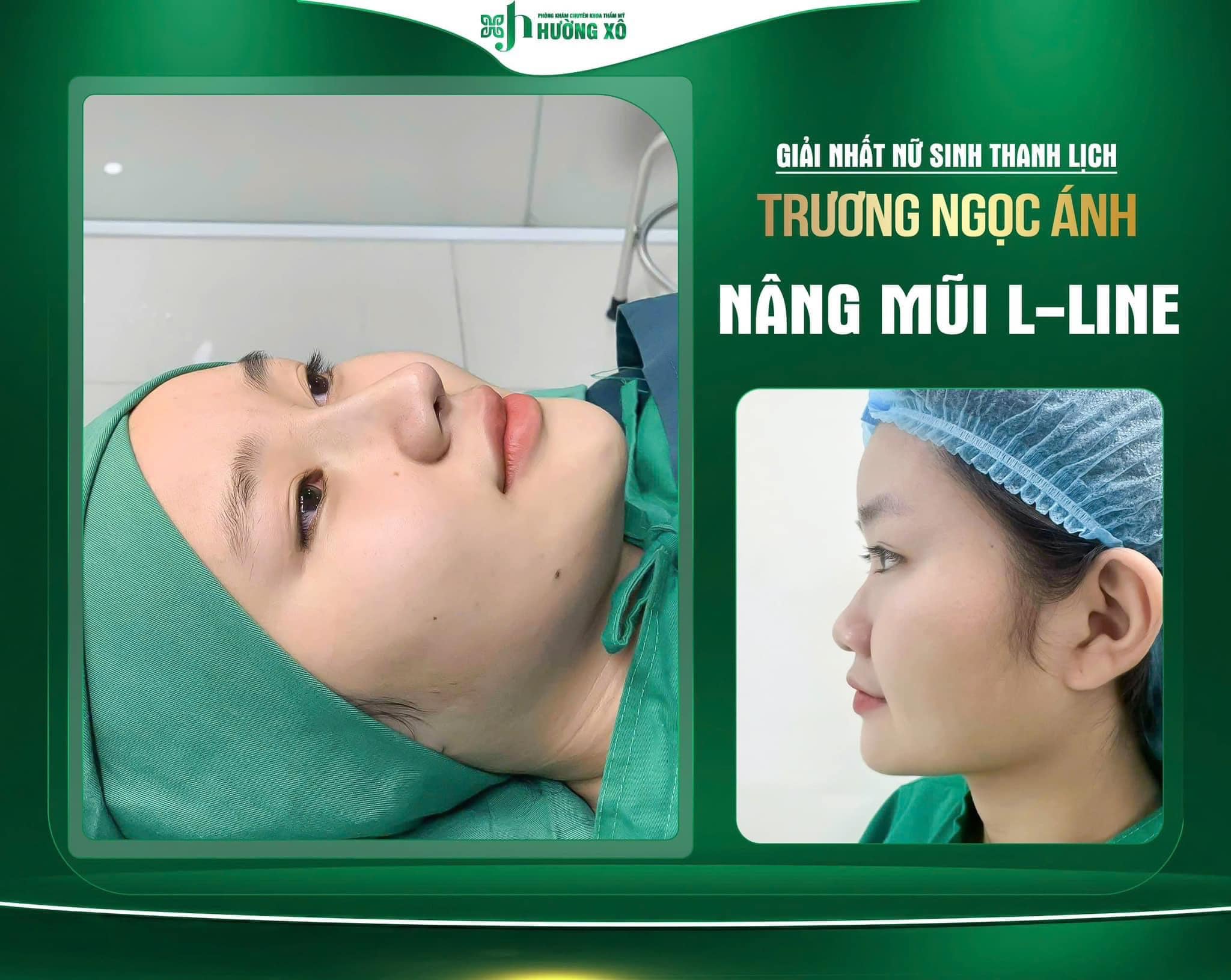Giải Pháp Làm Đẹp Nâng Mũi L Line Tại Hà Tĩnh