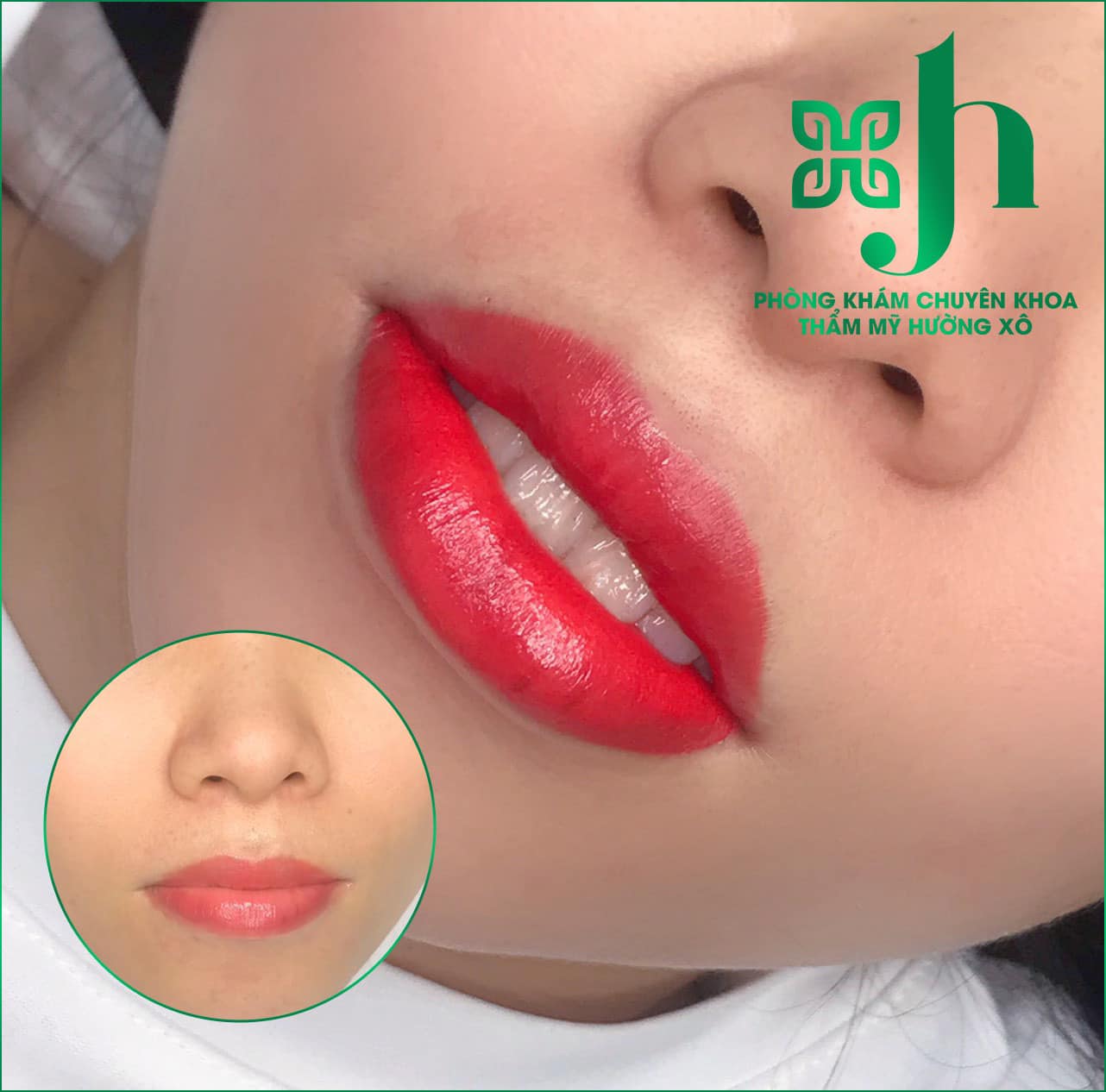 Trải Nghiệm Dịch Vụ Phun Môi Collagen Tại Vinh