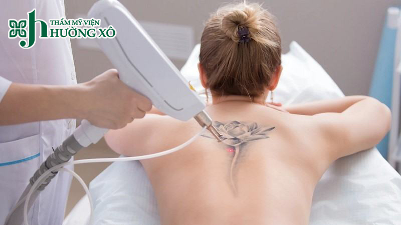 Địa Chỉ Xoá Xăm Uy Tín Tại Vinh