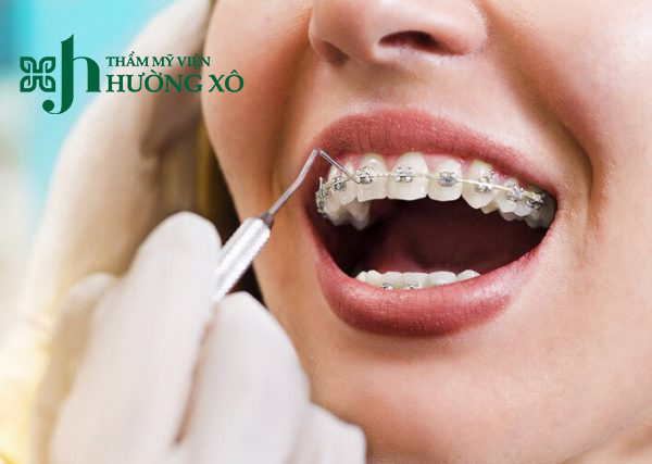 Dịch Vụ Niềng Răng Uy Tín Tại Vinh