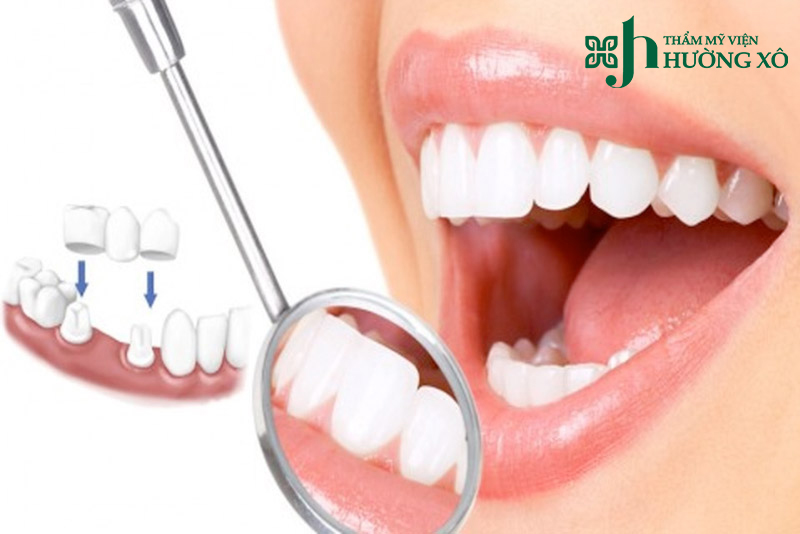 Tìm Hiểu Địa Chỉ Bọc Răng Sứ Uy Tín Tại Vinh