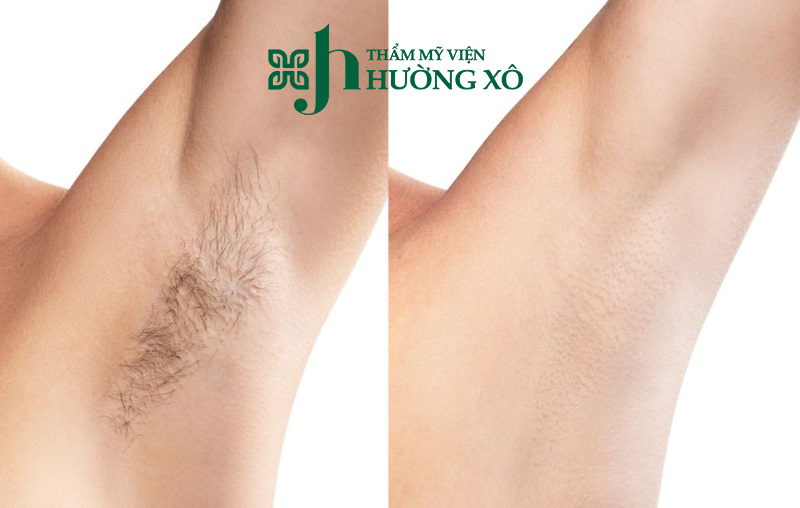 Đơn Vị Triệt lông Nách Uy Tín Tại Vinh