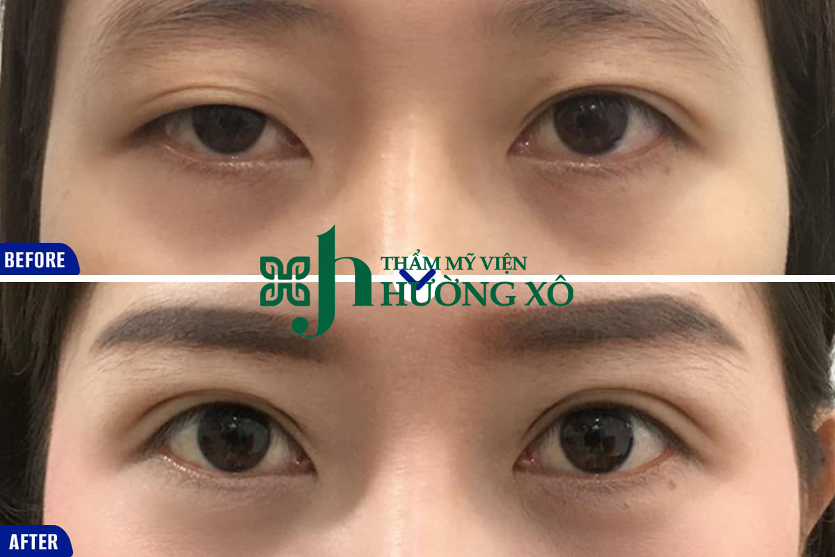 Địa Chỉ Phẫu Thuật Sụp Mí Mắt Uy Tín Tại Vinh