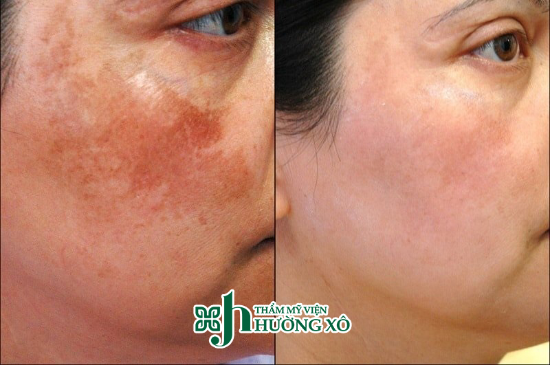 Địa Chỉ Điều Trị Nám Da Uy Tín Tại Vinh
