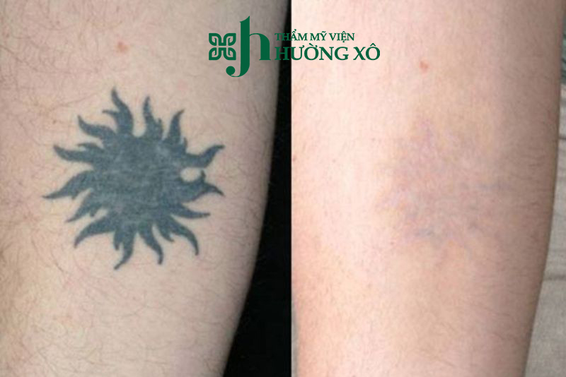 Dịch Vụ Xoá Xăm Uy Tín Tại Vinh